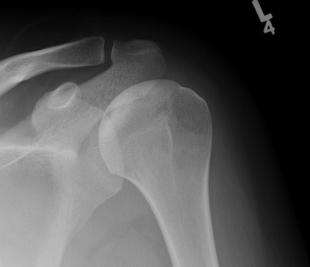Humeral AVN Stage 2
